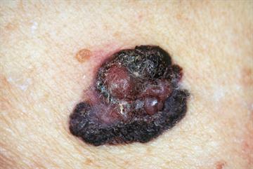 Developments in melanoma treatment