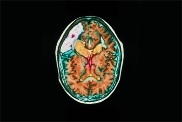 Clinical Review: Stroke - epidemiology, diagnosis and management