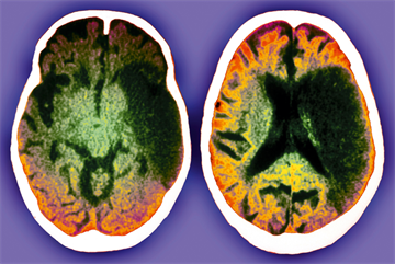 Viewpoint: Statins in ischaemic stroke prevention