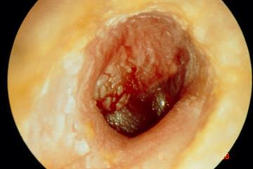 Clinical review - Turner syndrome