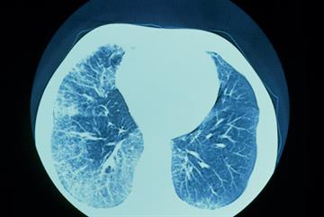 Lung disease in patients with rheumatoid arthritis