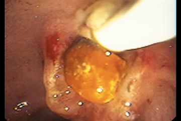 Common bile duct stones - clinical review