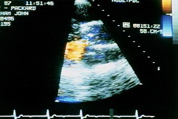 Aortic valve disease: clinical review