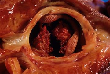 Clinical review of infective endocarditis: diagnosis and management