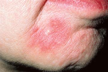 Case study - Recurrent tiredness and joint pains