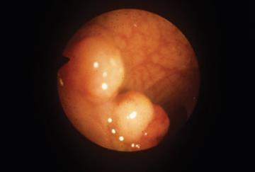 Viewpoint - NHS bowel scope screening for colorectal cancer