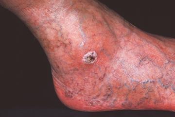 Red flag symptoms - Absent peripheral pulses