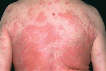 Pictorial case study - A reaction to penicillin