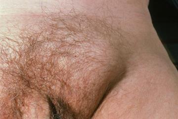 Red flag symptoms - Groin swelling