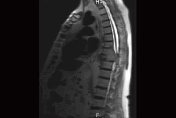 Clinical Review: Multiple myeloma