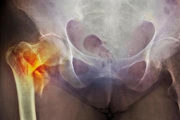 Fracture risk, BP monitoring and screening for COPD: journals update May 2016