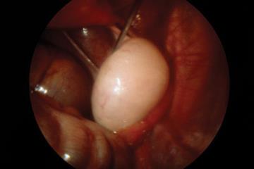 Long-term health consequences of polycystic ovary syndrome