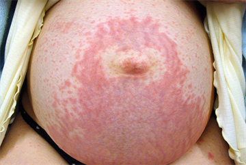 Skin changes and complaints in pregnancy