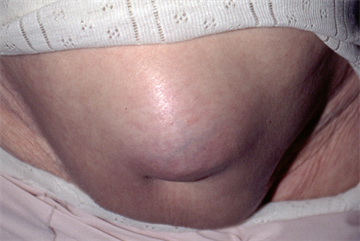 Differential diagnoses: Abdominal swellings