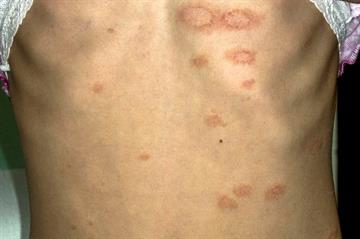 Differential diagnosis: Pityriasis