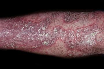 Psoriasis: differential diagnosis