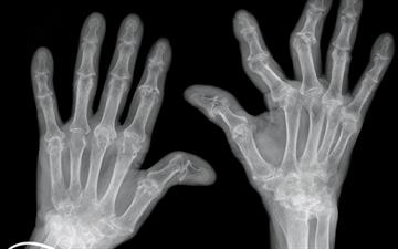 Rheumatoid arthritis: clinical review