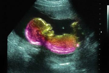 Gestational diabetes in early pregnancy linked to autism