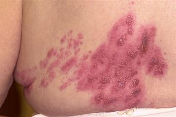 Clinical images - Diagnosing a blistering rash
