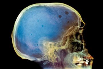Multiple myeloma