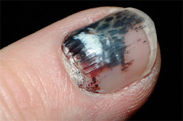 Differential diagnoses: Painful nails