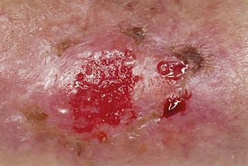 Red flag symptoms - Leg ulcers