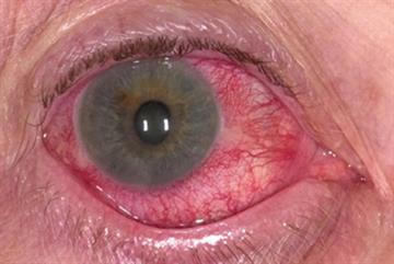 Differential diagnoses - Conjunctivitis and iritis in pictures