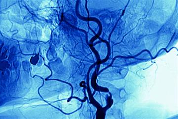 Clinical Review: Transient ischaemic attack