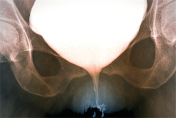 Urinary incontinence in women: clinical review