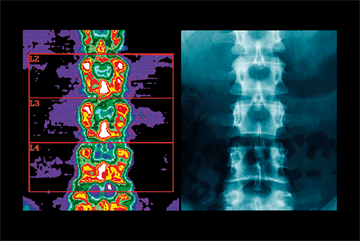 Assessing bone health in adults and children
