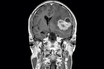 Clinical review of brain tumours: diagnosis and management