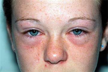 Case study: Hayfever in an adolescent