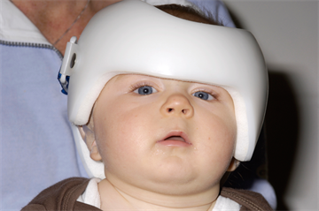 Journals watch: Helmets for baby skull deformities | Undescended testis | Mood stabilisers