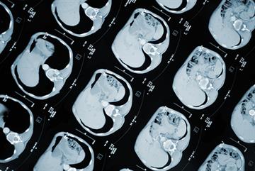 Breath testing for cancer could be rolled out in GP practices within five years