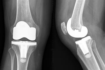 Total knee replacement