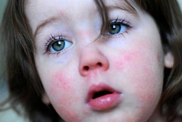 Pressure to cut antibiotic use contributing to outbreaks of scarlet fever, say GPs