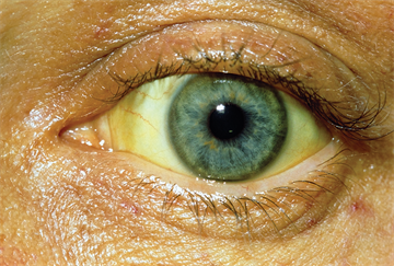 Red flag symptoms: Jaundice