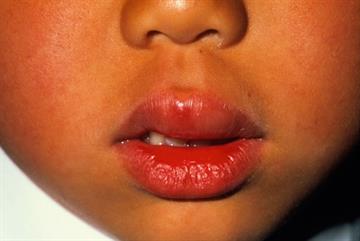 How to manage severe allergies in primary care
