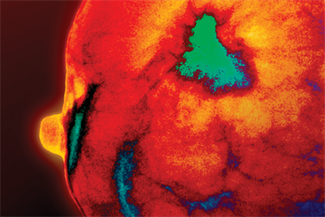 Journals watch: Osteoarthritis, HRT, back pain and bariatric surgery