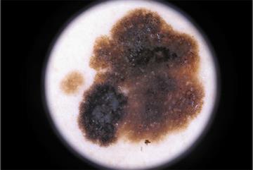 Using dermoscopy to diagnose skin lesions