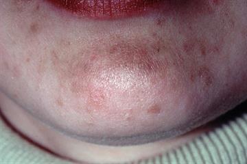 Differential diagnoses: Pigmentation