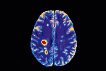 Multiple sclerosis: clinical review