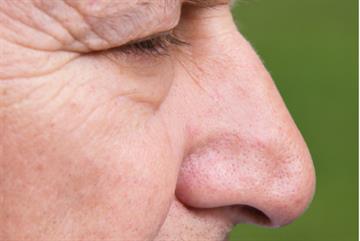 Loss of smell 'a predictor of five-year mortality'