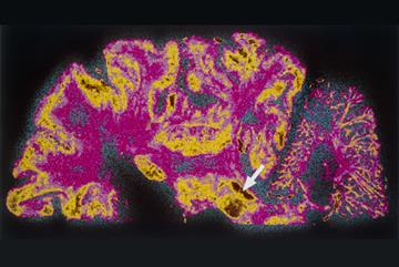 Studies suggest possible future treatments to reverse Parkinson's