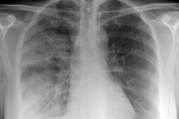 GPs urged to refer high-risk pneumonia cases
