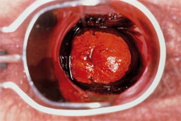 Viewpoint - Assessment of HPV vaccination