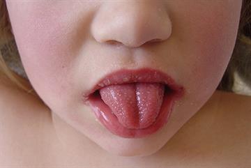 Scarlet fever cases surge to more than twice seasonal average