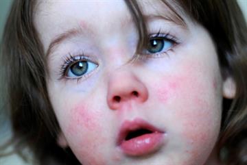 Scarlet fever cases last week exceeded all previous records, GPs warned