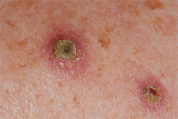 Pancreatic glucagonoma - case study