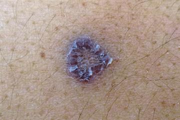 Case study: A new, solitary lesion on pigmented skin